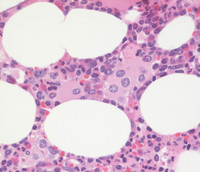 Dysplastic megakaryocytes