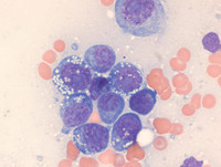 Multiple myeloma - Marrow