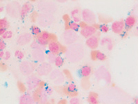 Ringed sideroblasts (iron stain)