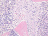 Mastocytosis, bone marrow