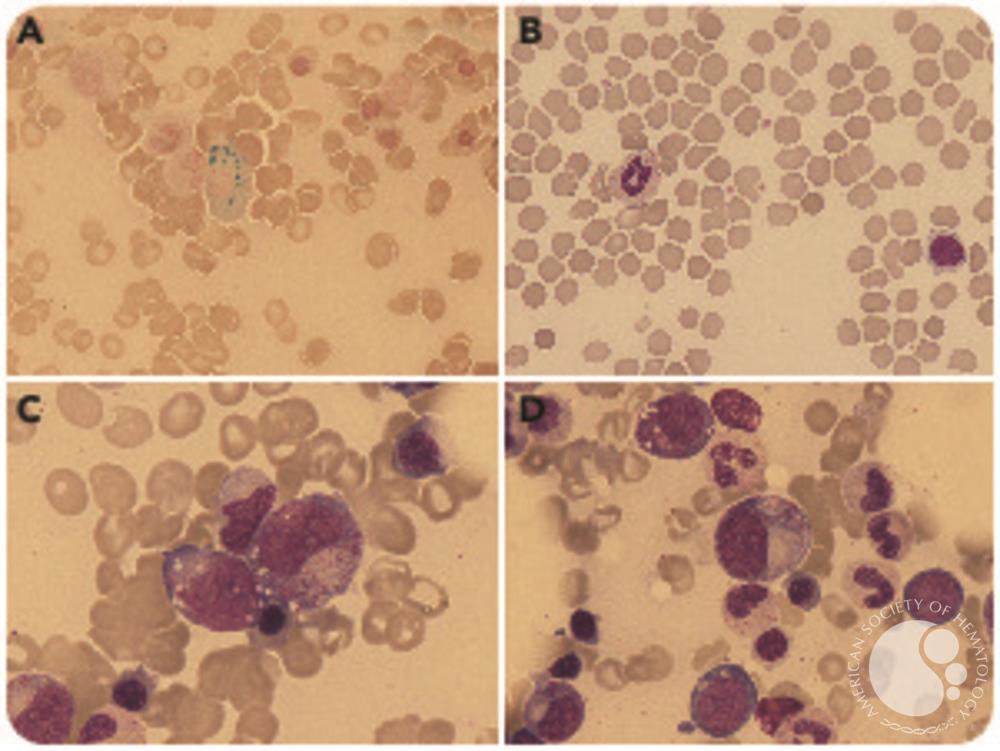 Differential diagnosis of myelodysplastic syndrome: anemia associated with copper deficiency