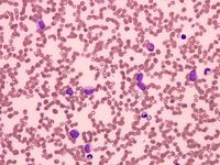 Acute Myeloid Leukemia 1