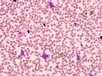 Acute Myeloid Leukemia 2