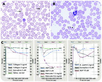 Abnormalities of platelet aggregation associated with giant granules in a subset of platelets