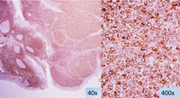 LBCL with IRF4 BCL2