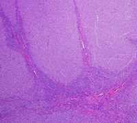 Large B-cell lymphoma with IRF4 rearrangement