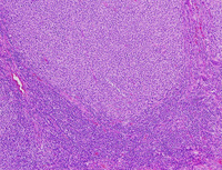 LBCL-with-IRF4-HE-Low-100x