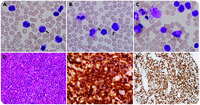 ALK small cell variant of anaplastic large cell lymphoma with leukemic presentation