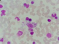 Leishmania visualization on bone marrow aspiration sample 2