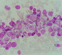 Leishmania visualization on bone marrow aspiration sample 4