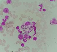 Leishmania visualization on bone marrow aspiration sample 5