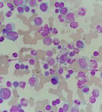 Leishmania visualization on bone marrow aspiration sample 6