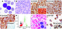 Plasma cell leukemia presenting as “lymphocytosis”