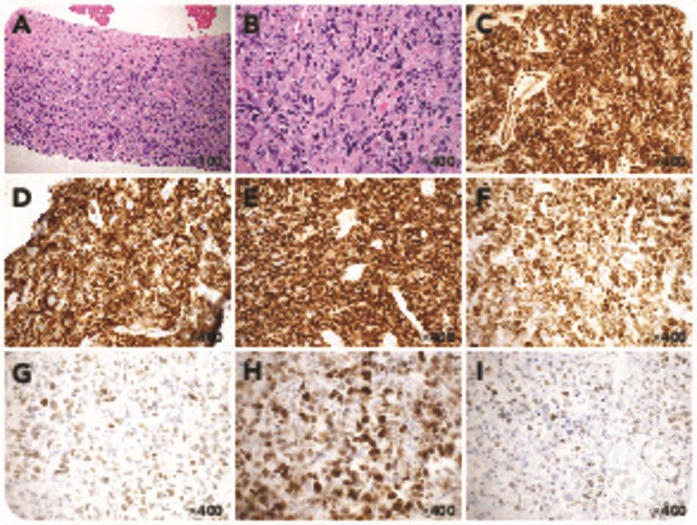 Diffuse Large B Cell Lymphoma With Strong Aberrant Expression Of Cd31