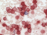 AML, monocytic Esterase stain