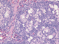 Lipogranuloma