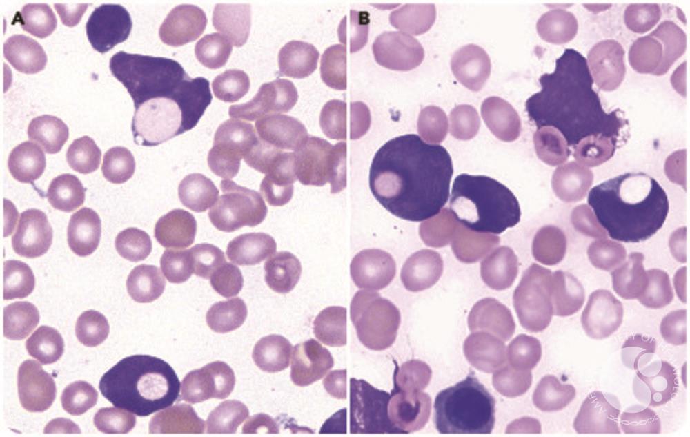 Frequent erythrophagocytosis by leukemic blasts in B-cell acute lymphoblastic leukemia