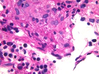 Disseminated histoplasmosis with bone marrow infiltration and secondary HLH 1