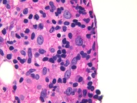 Disseminated histoplasmosis with bone marrow infiltration and secondary HLH 2