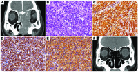 25-Hydroxyvitamin D-1α-hydroxylase– and multiple cytokine–producing diffuse large B-cell lymphoma