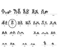 monosomy 21 karyotype