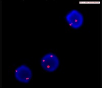 FISH showing Trisomy 12 in chronic lymphocytic leukemia (CLL)