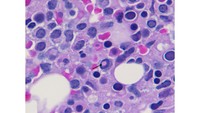 Dutcher Body in Recurrent Lymphoplasmacytic Lymphoma