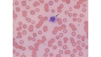 Rouleaux in a Peripheral Smear, Multiple Myeloma