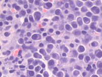 Plasma Cells in Bone Marrow Core Biopsy, Multiple Myeloma