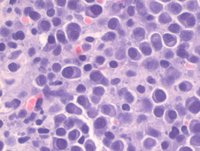 Plasma Cells In Bone Marrow Core Biopsy Multiple Myeloma