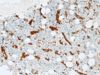 hepatosplenic T cell lymphoma 3