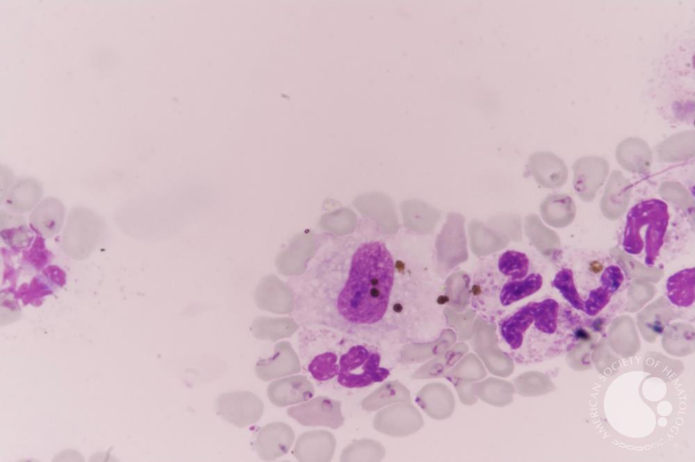 Falciparum-Pigment-laden macrophage