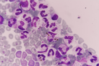 Falciparum-Pigments-laden neutrophils