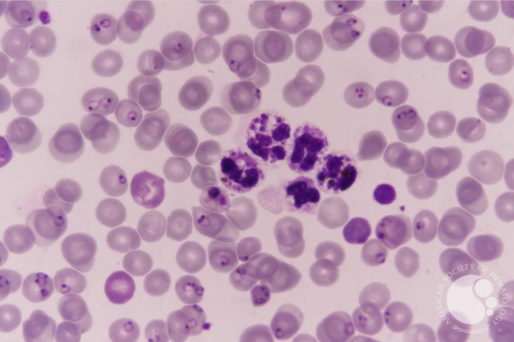 Falciparum-Merozoites or parasite remnants