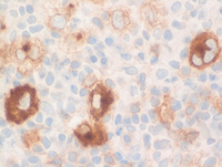 Classical Hodgkin Lymphoma CD30