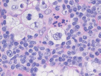 Lacunar Cells in Classical Hodgkin Lymphoma