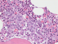 bone marrow core biopsy