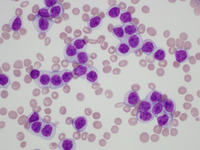 Auer Rod-like inclusion in Lymphoma