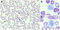 Gray platelet syndrome mimicking atypical autoimmune lymphoproliferative syndrome: the key is in the blood smear