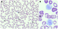 Gray Platelet Syndrome Mimicking Atypical Autoimmune Lymphoproliferative Syndrome The Key Is In 4287