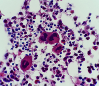 idiopathic thrombocytopenic purpura smear