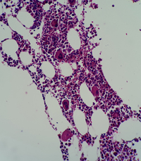 Immune thrombocytopenic purpura (ITP) bone marrow biopsy view 5