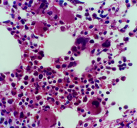 Immune thrombocytopenic purpura (ITP) bone marrow biopsy view 7