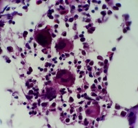 Immune thrombocytopenic purpura (ITP) bone marrow biopsy view 8