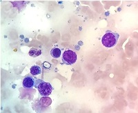 Lymphoglandular Bodies in bone marrow aspirate in a case of B cell lymphoma