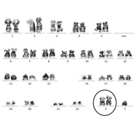 A gain of X chromosome as a sole abnormality in an adult ALL patient