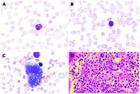 Visceral leishmaniasis presenting with pancytopenia and circulating blastlike lymphocytes