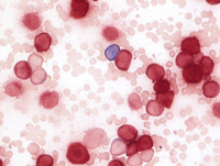 Acute Monocytic Leukemia Wikipedia, 47% OFF