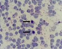 Presence of nucleated RBCs (NRBCs) in peripheral blood smear 3