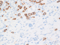 CHLNS CD20